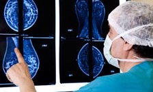 First genetic link to difficult-to-diagnose breast cancer sub-type discovered